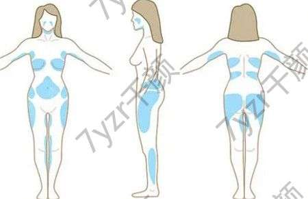 吸脂手術(shù)會留疤嗎?術(shù)后要注意什么